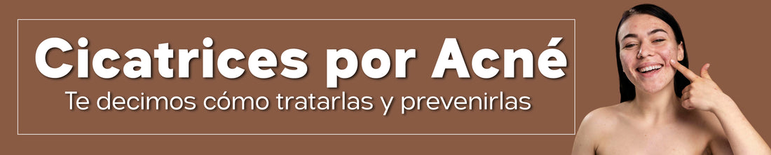 Cicatrices por acné: cómo tratarlas y prevenirlas