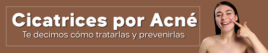 Cicatrices por acné: cómo tratarlas y prevenirlas